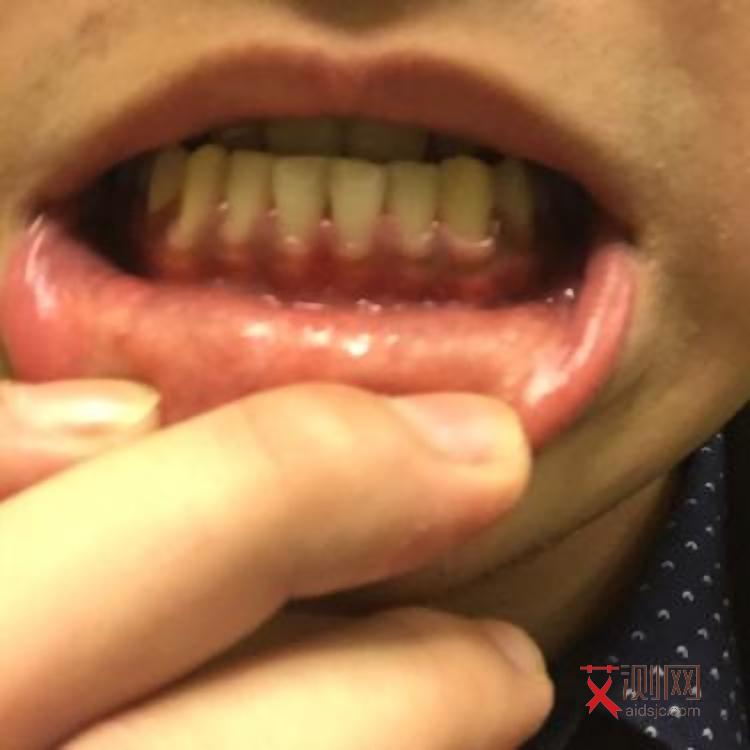 艾滋病皮肤症状会痒用什么药