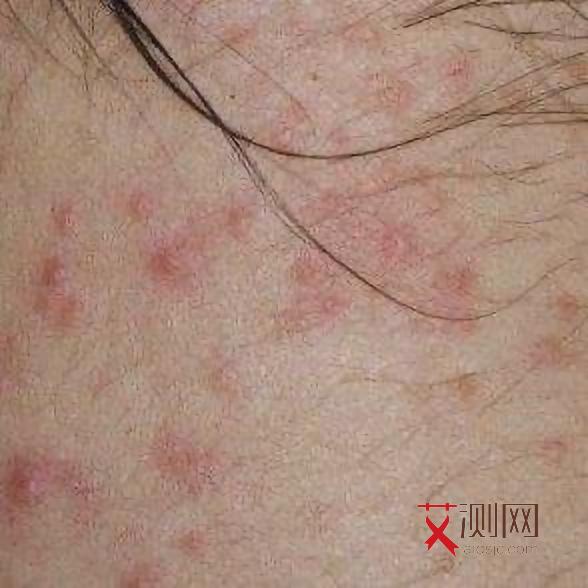 艾滋病男人初期有什么征兆表现吗