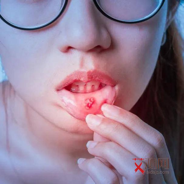 艾滋病红点多久出现