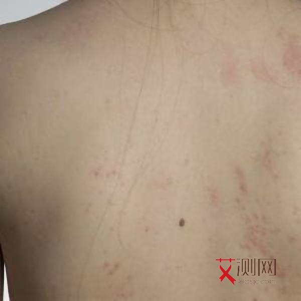 艾滋病红疹几天长满全身