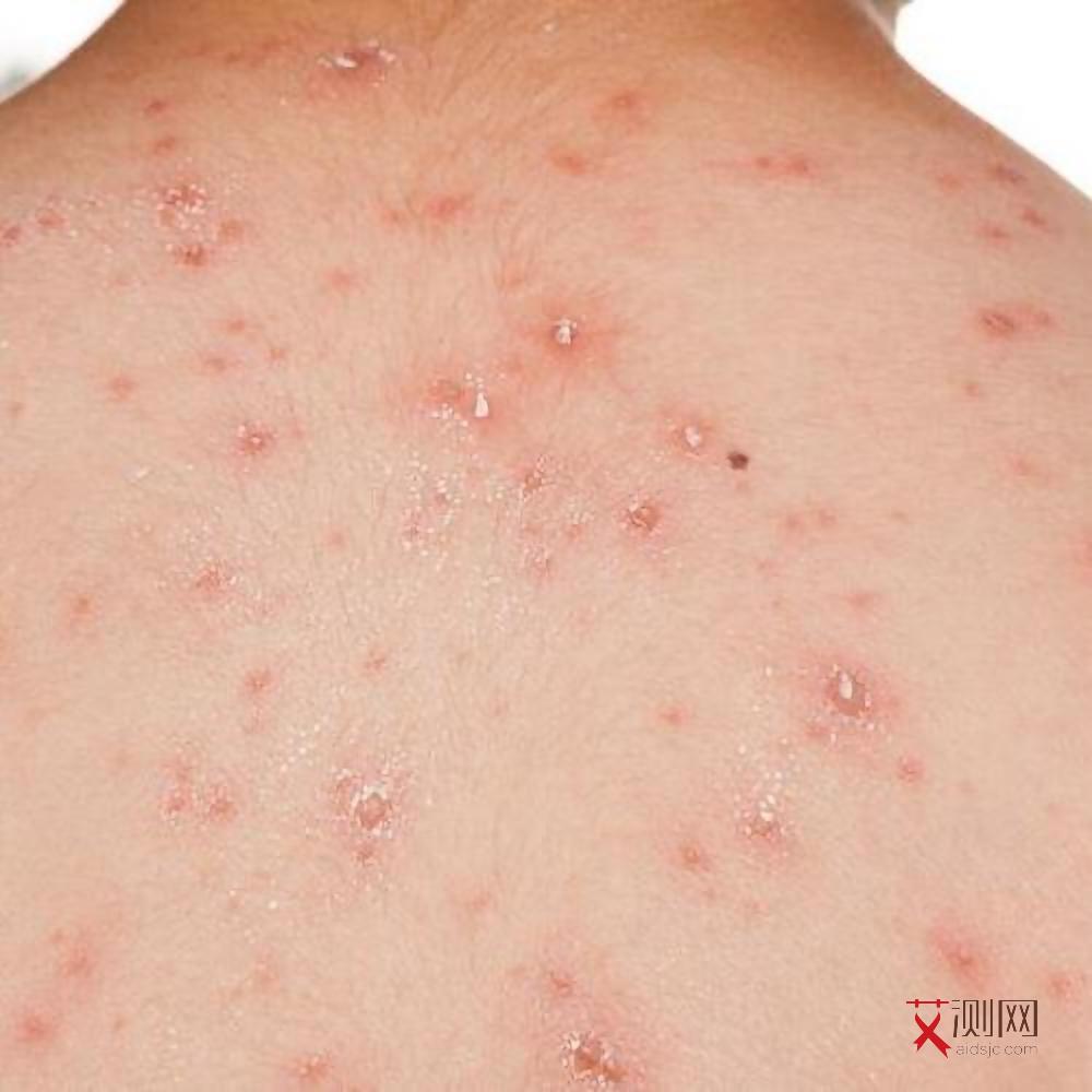 艾滋病初期的皮疹是一两颗还是很多颗