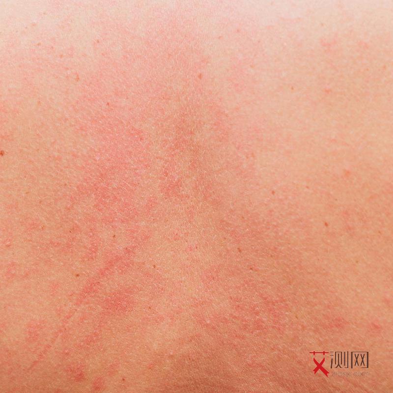 艾滋病人的唾液会不会传染给他人