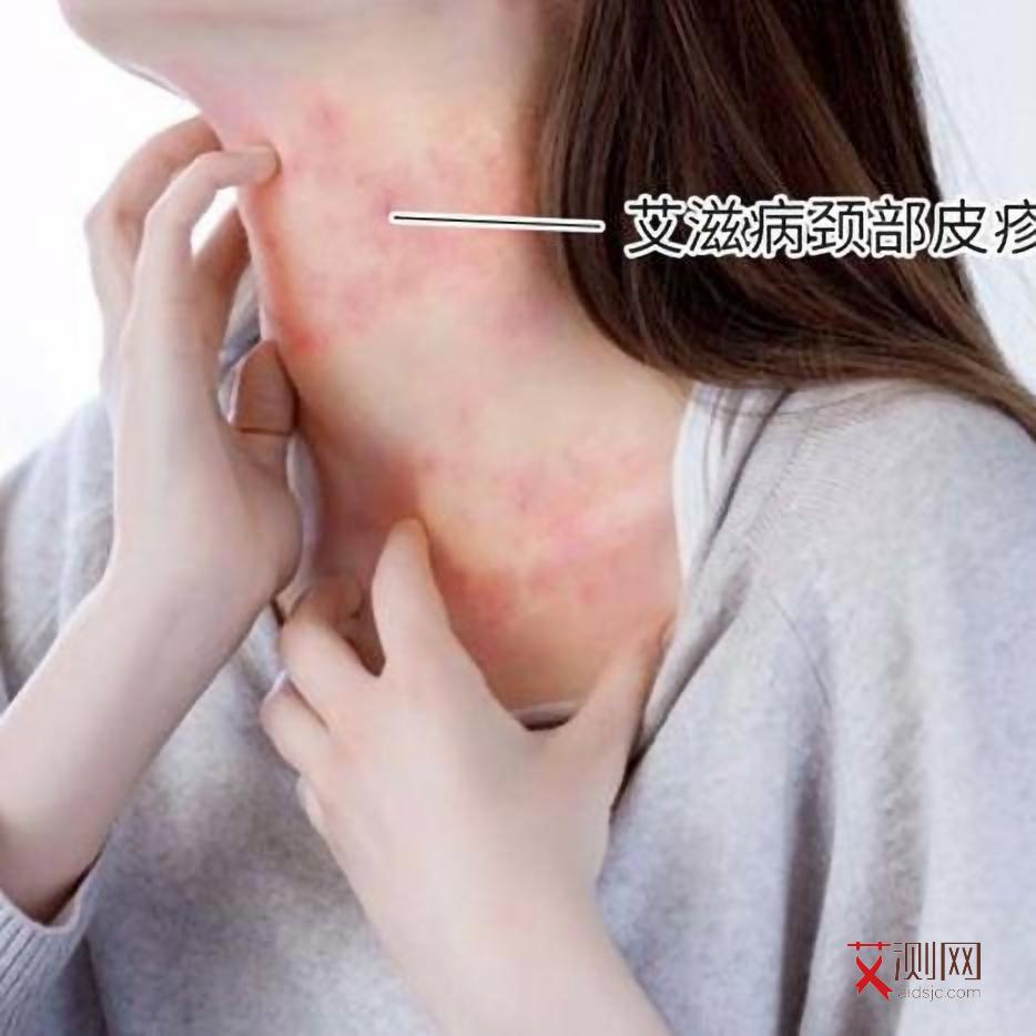 艾滋病有症状的多还是无症状的多呢