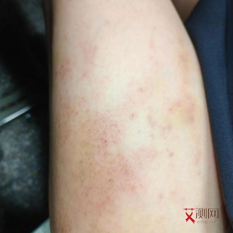 艾滋病初期小红点多少个才算