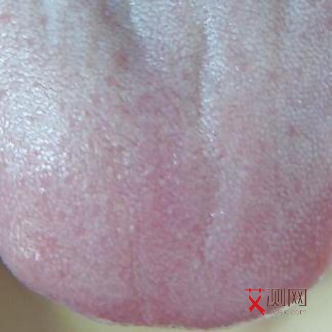 艾滋病皮肤症状会痒用什么药