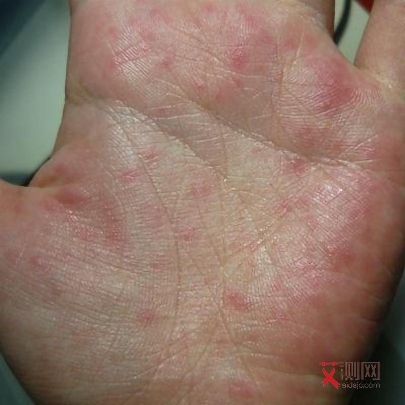 感染了艾滋病可以活多久啊女性