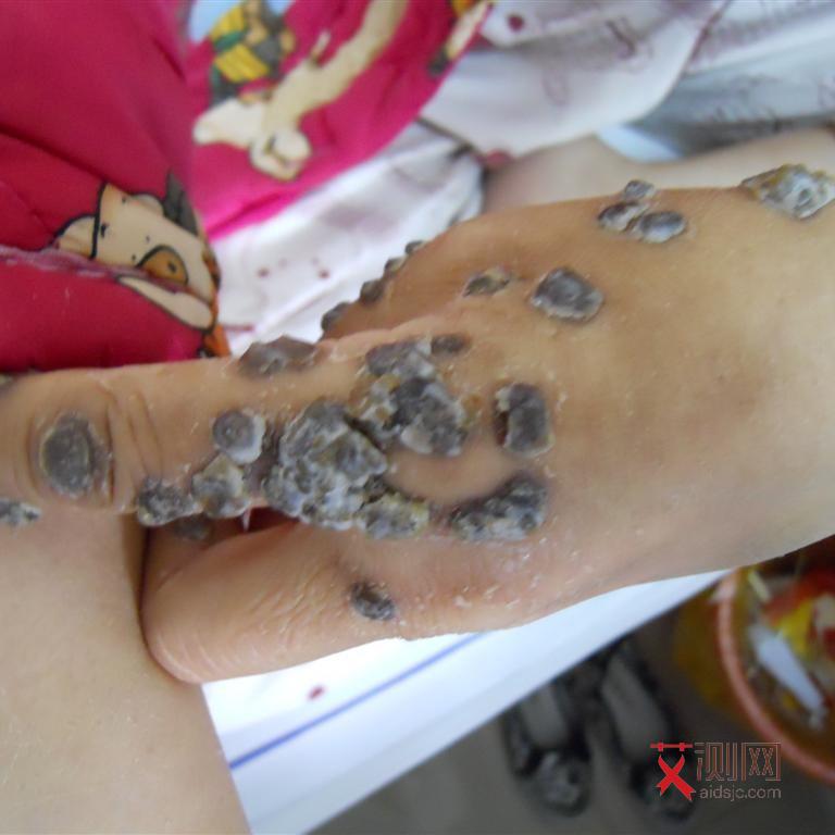 石家庄艾滋病检查