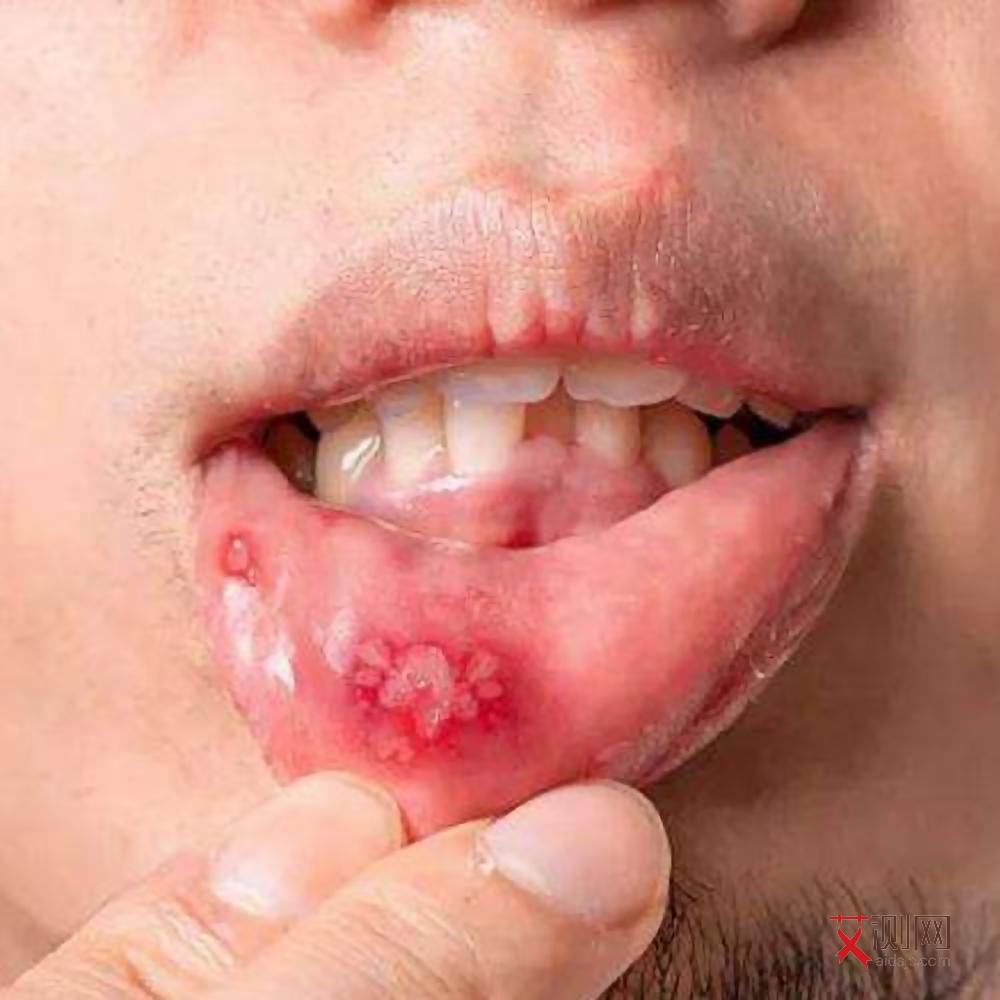 艾滋病感染初期身上会痒吗会传染吗