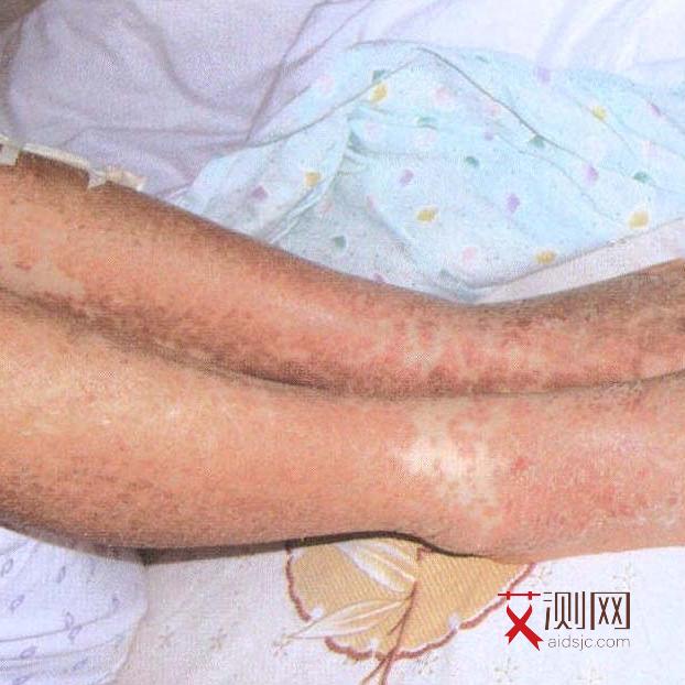 男性有艾滋病下体有什么症状图片