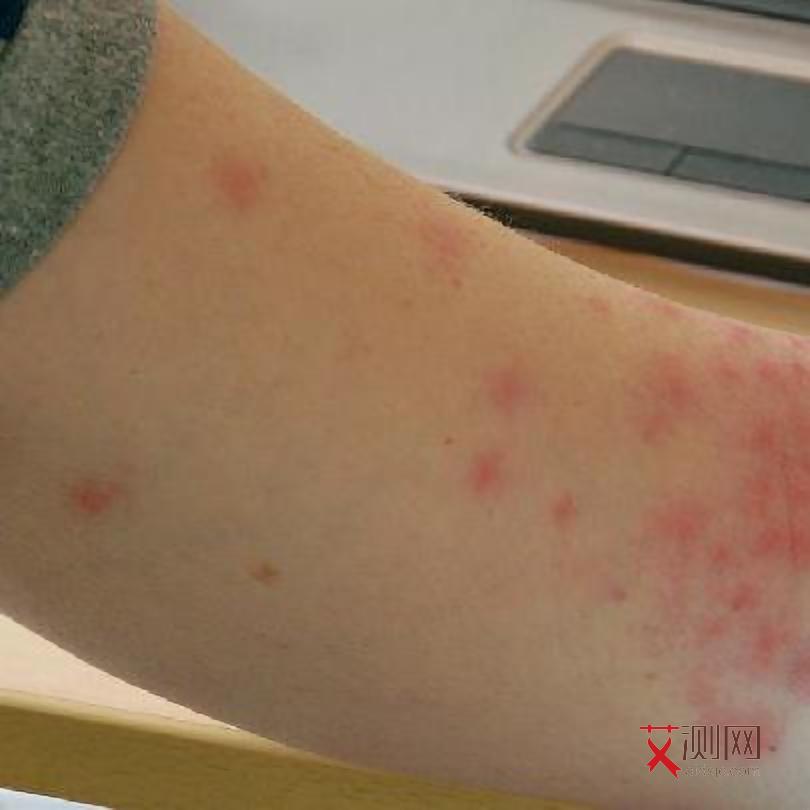艾滋病的前期征兆皮肤瘙痒怎么办