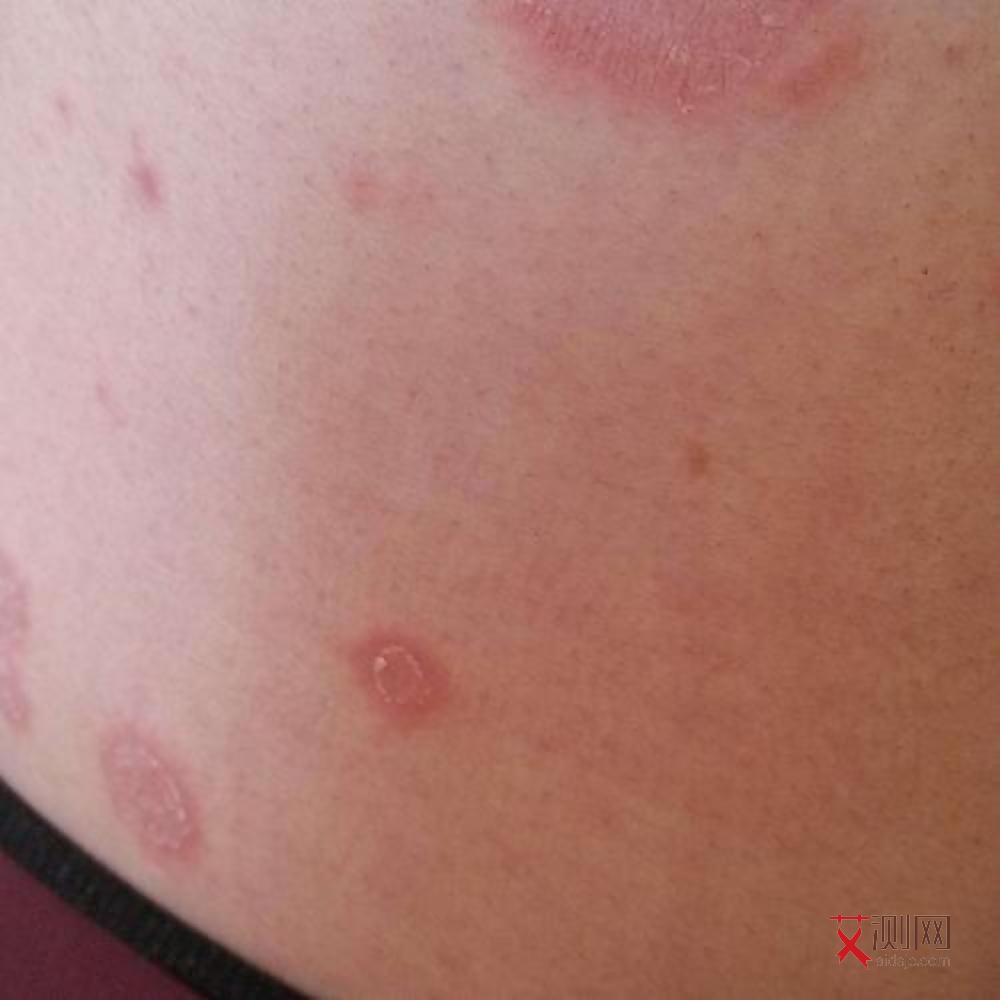 艾滋病多久身体会出现症状