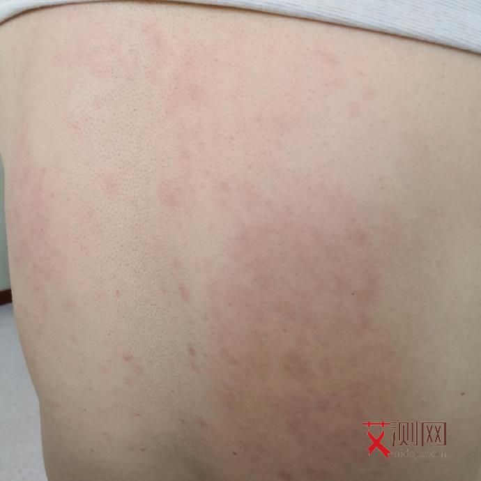 艾滋病的皮肤溃烂会烂几年吗图片