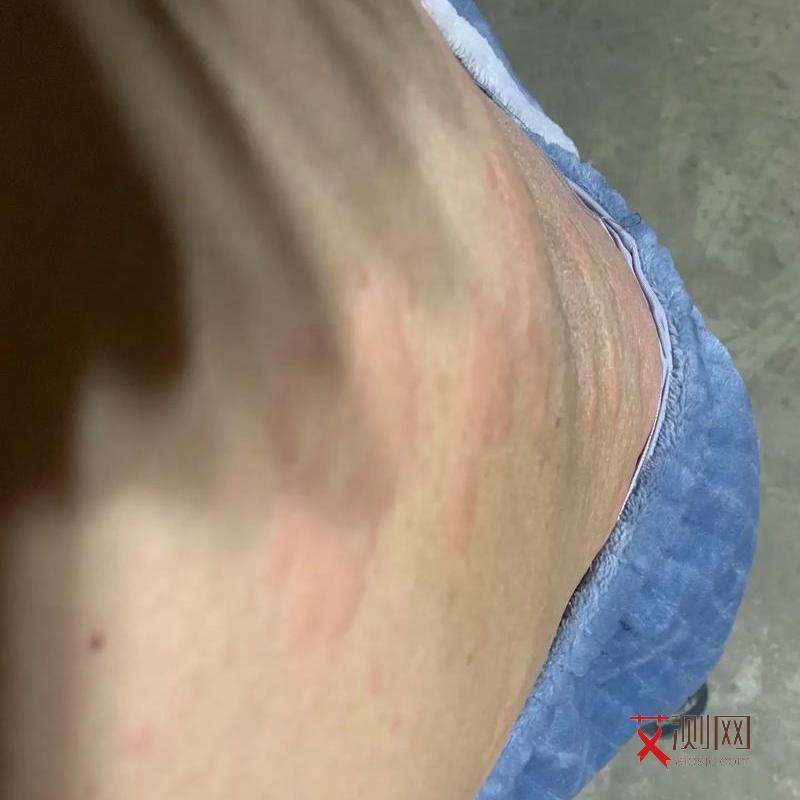 艾滋病人有什么症状表现呢女性