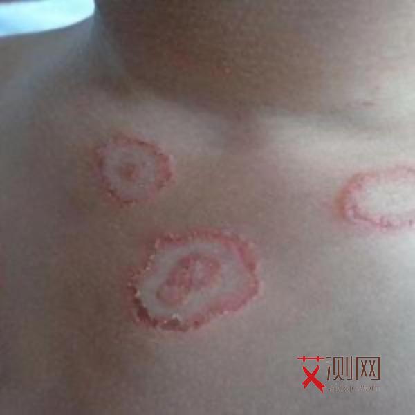 艾滋病的图片大全症状图