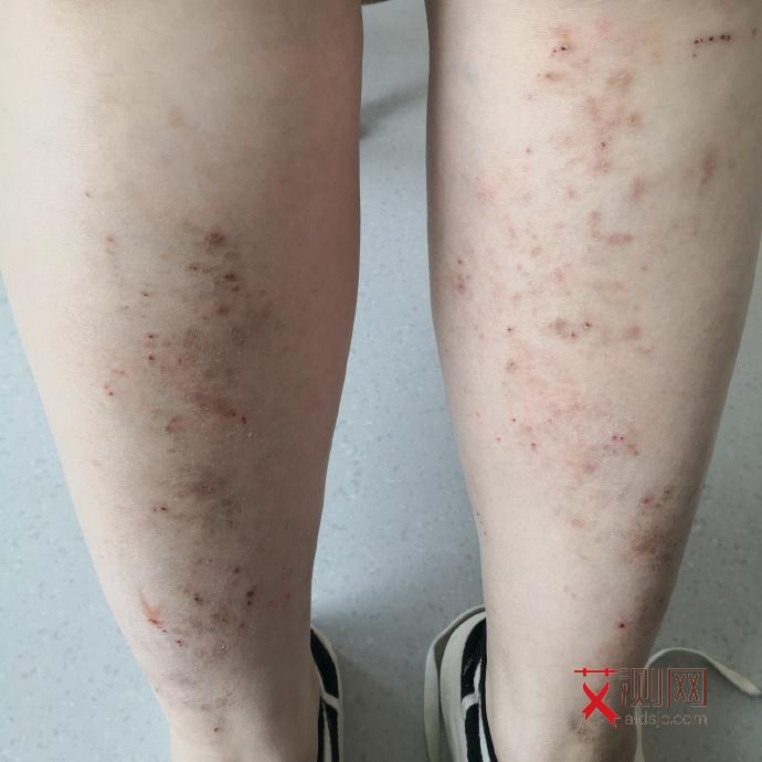 男性艾滋病人图片大全真实图