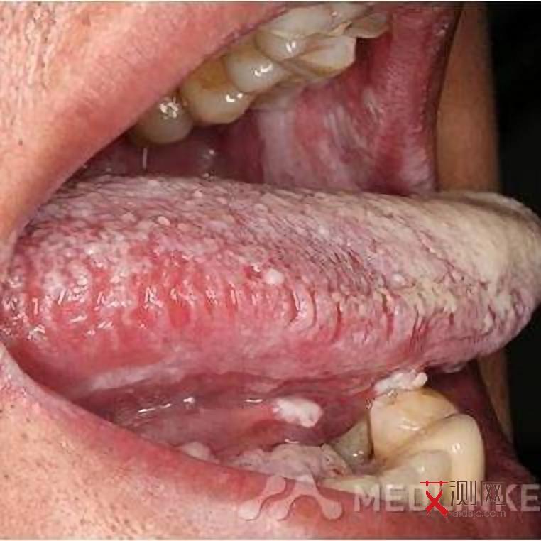 艾滋病初期皮下出血症状