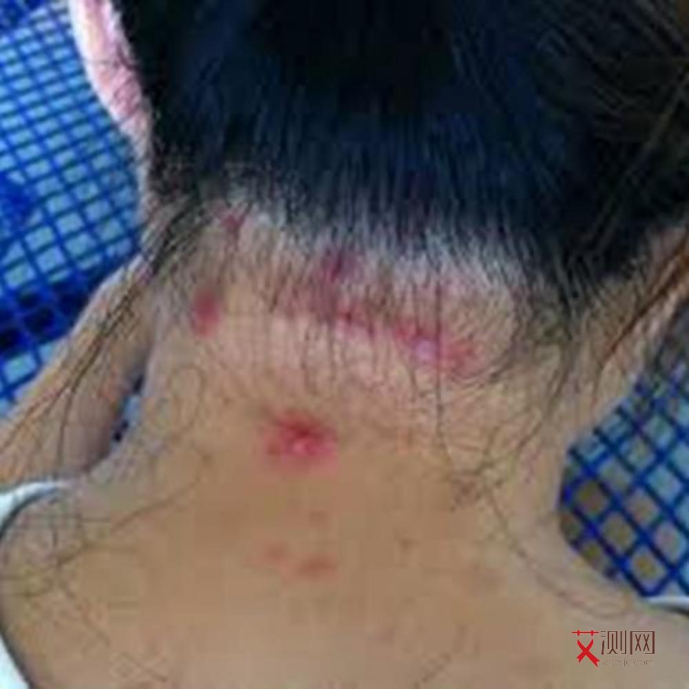 艾滋病红点多久出现