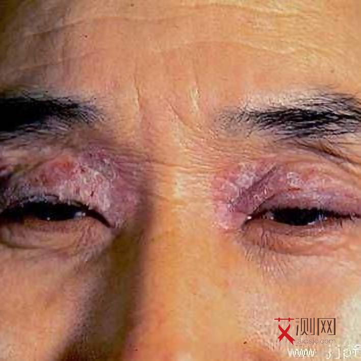 艾滋病器官有什么变化