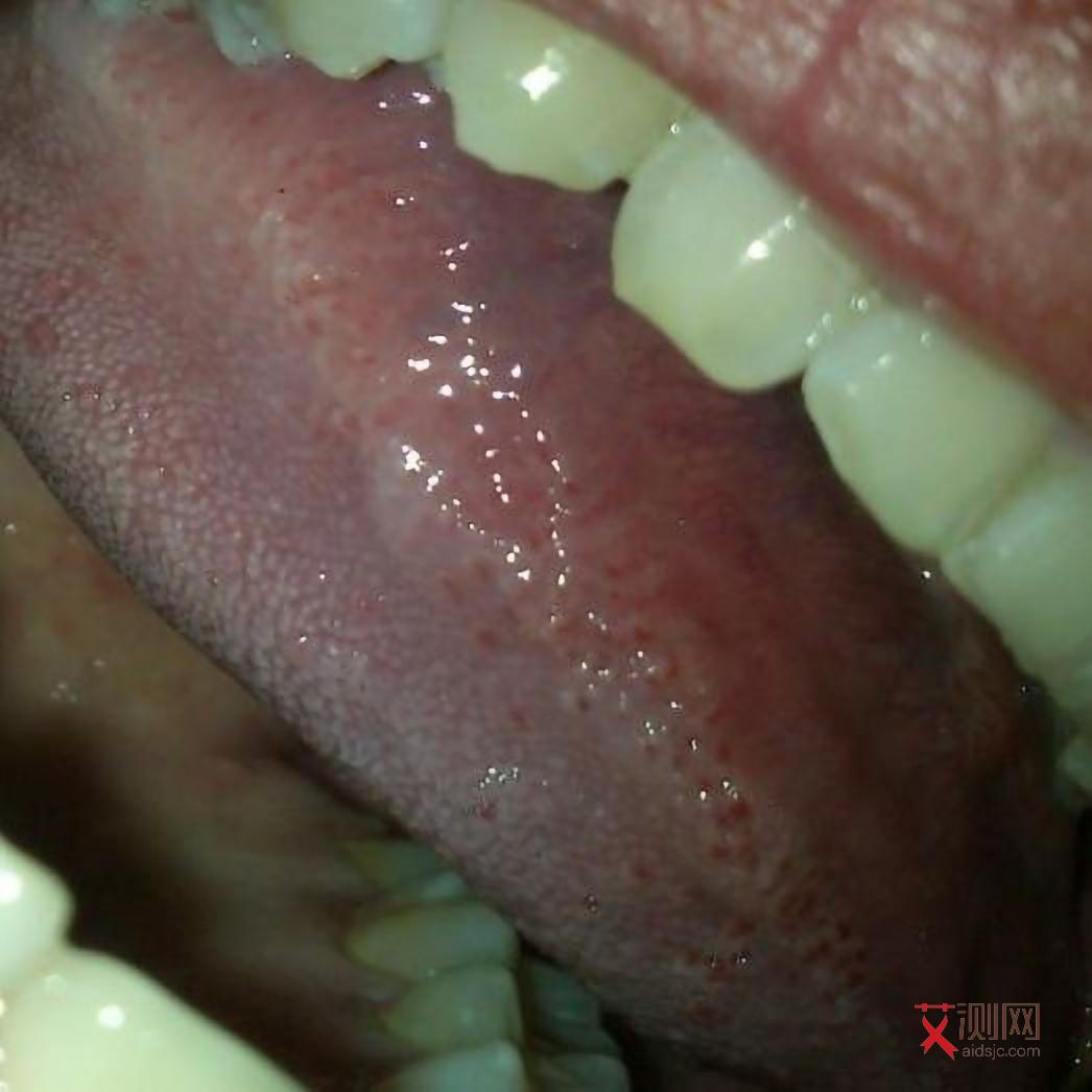 艾滋病的图片大全症状图