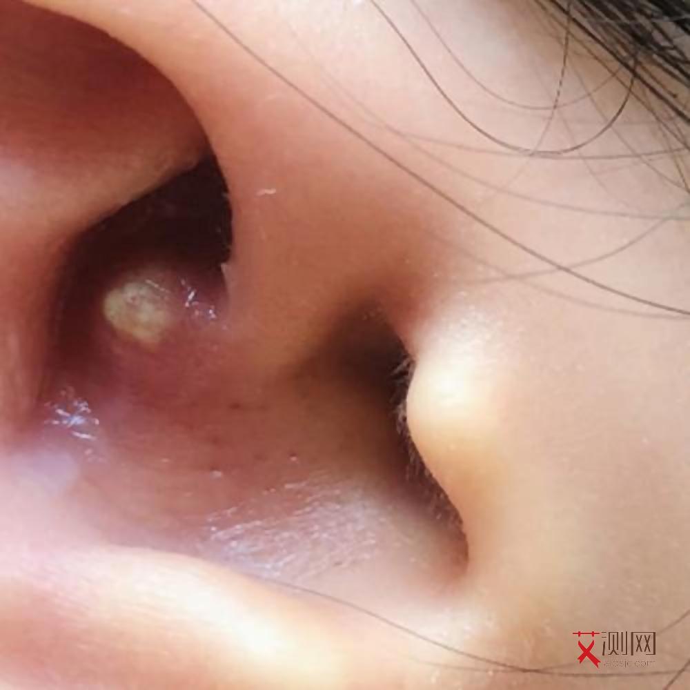 北京艾滋病患者有多少2025