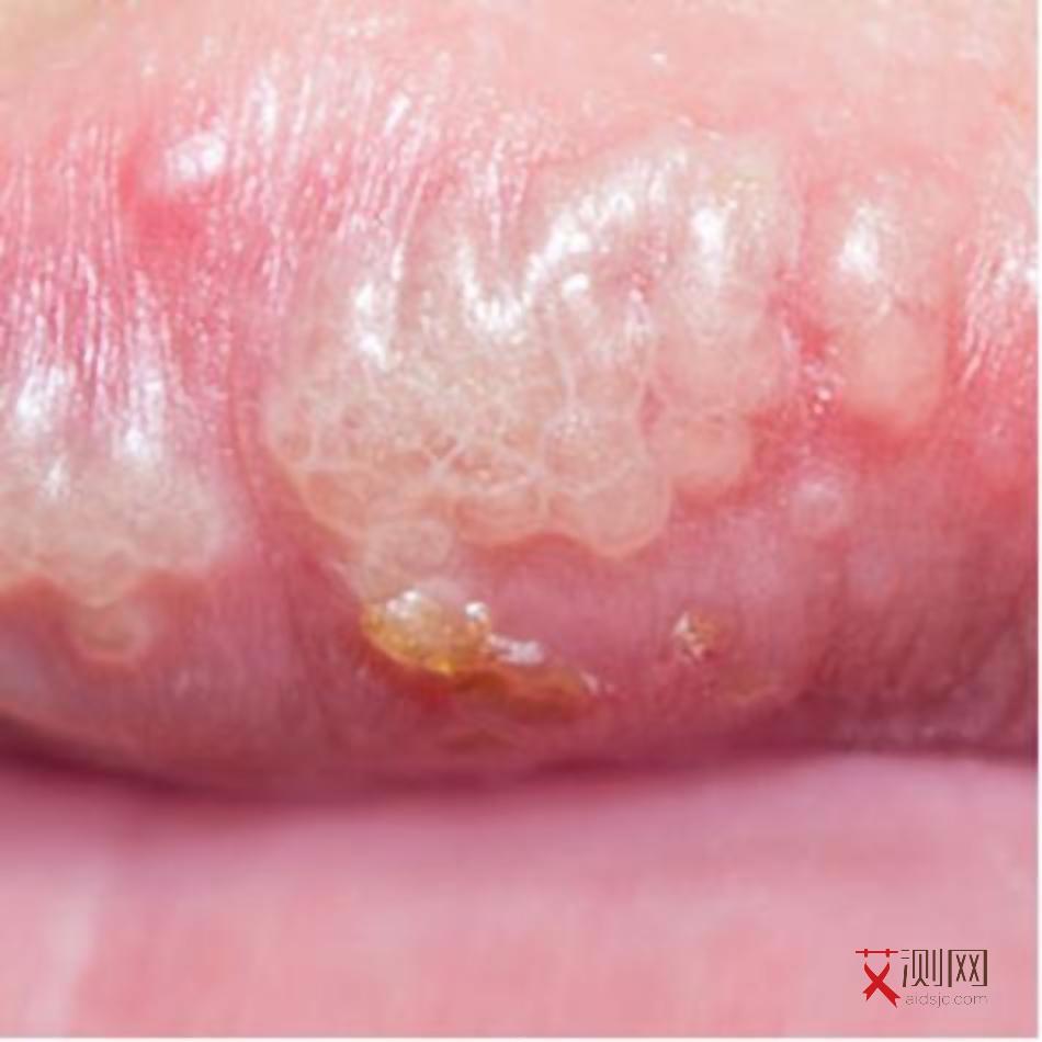 艾滋病身上症状会痒吗