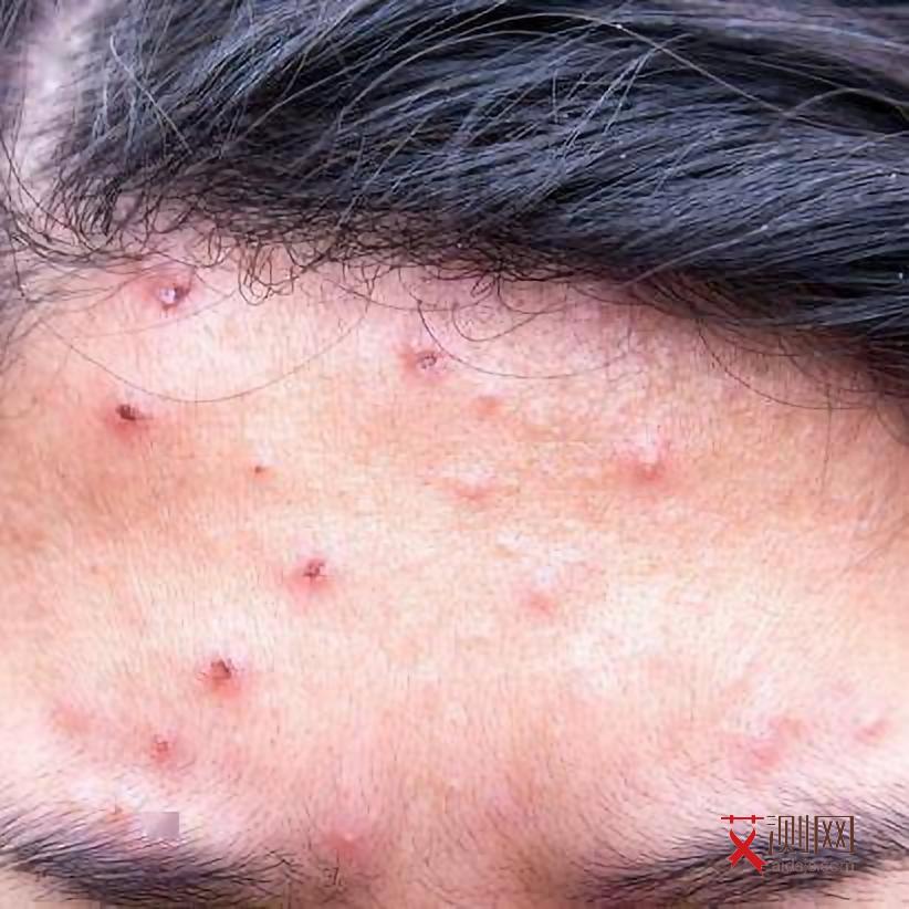 艾滋病初期都会发热吗?