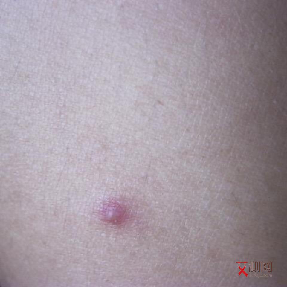 皮疹一两天下去了是艾滋病吗图片