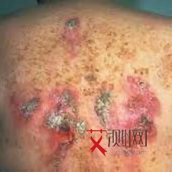 艾滋病溃疡多久自己恢复好了