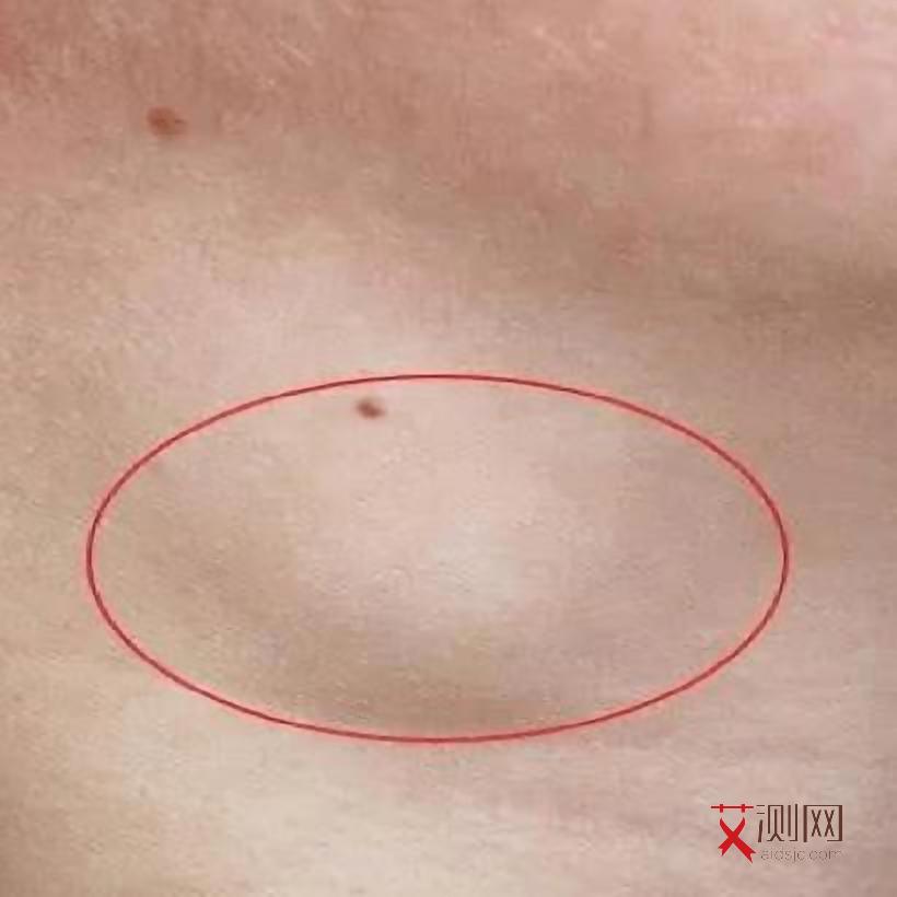 艾滋病几天有皮疹