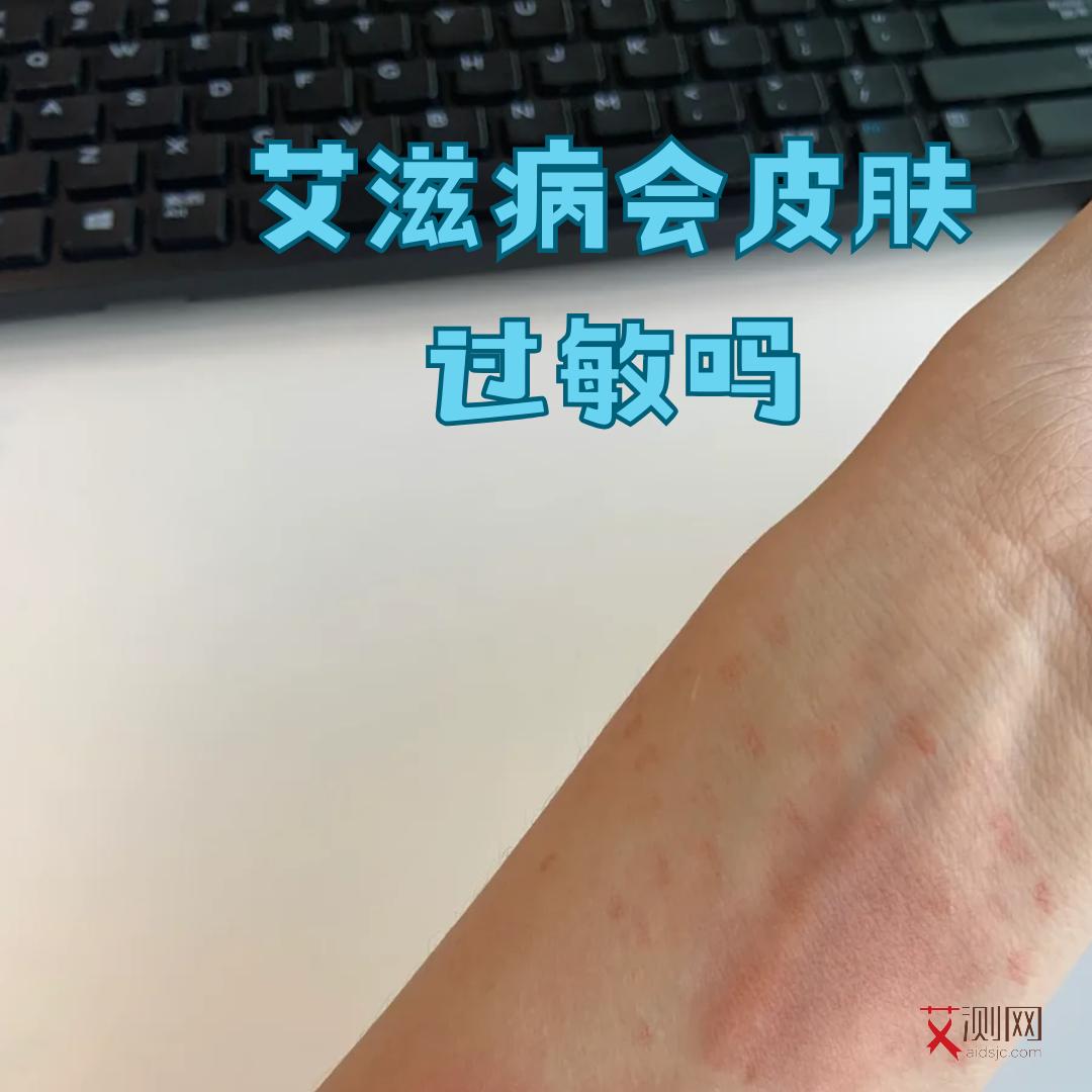 艾滋病下体瘙痒怎么办啊图片女性