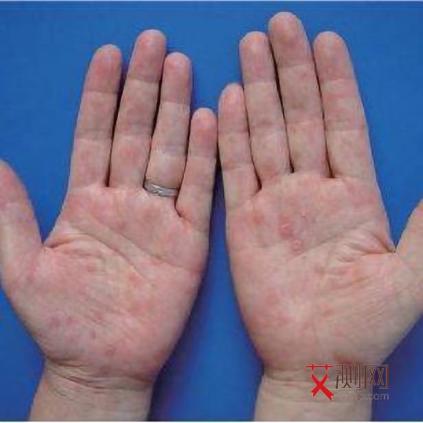 女人艾滋病早期会影响妇科吗