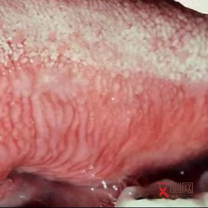 怎样检查自己有艾滋病毒感染