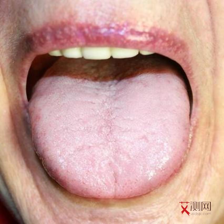 艾滋病 几个阶段