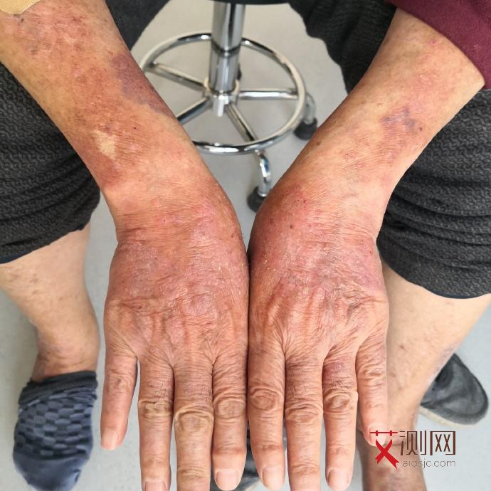 艾滋病早期胳膊上起的痘痘是什么