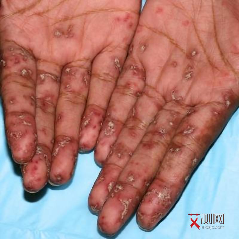 感染艾滋病多久会死