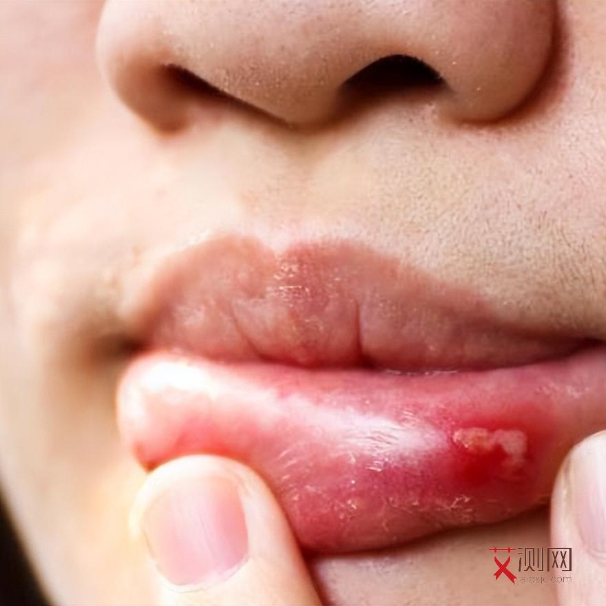 艾滋病的症状和治疗方法