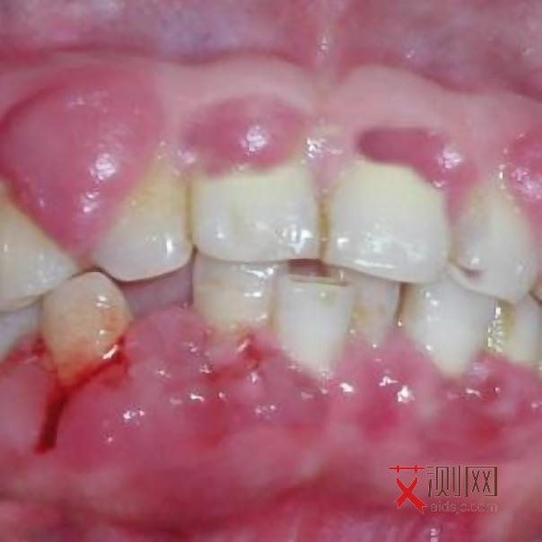 艾滋病病情发展过程图片