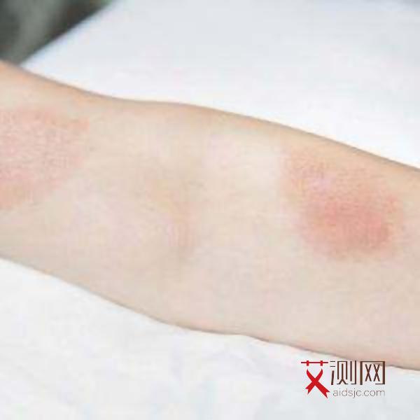 艾滋病皮肤痒不痒?