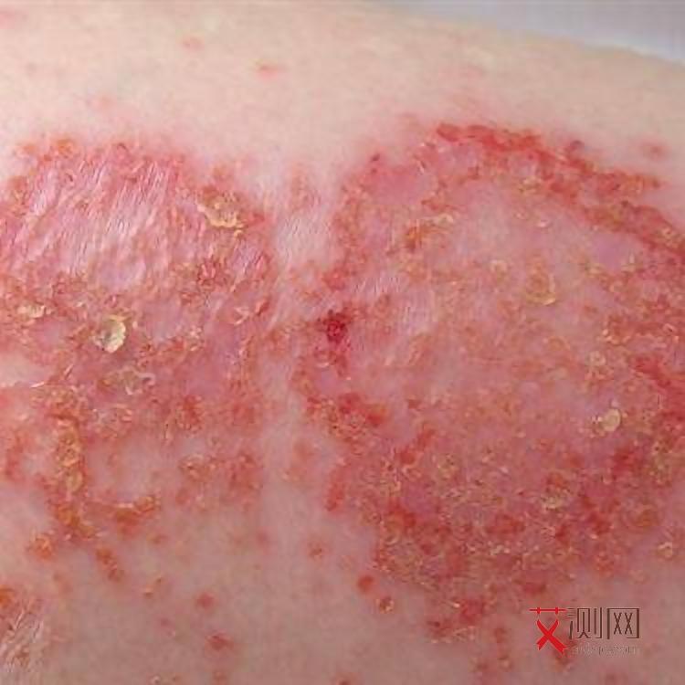 艾滋病有发热的症状吗