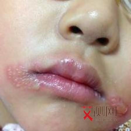 艾滋病有症状可以检测出来吗会传染吗