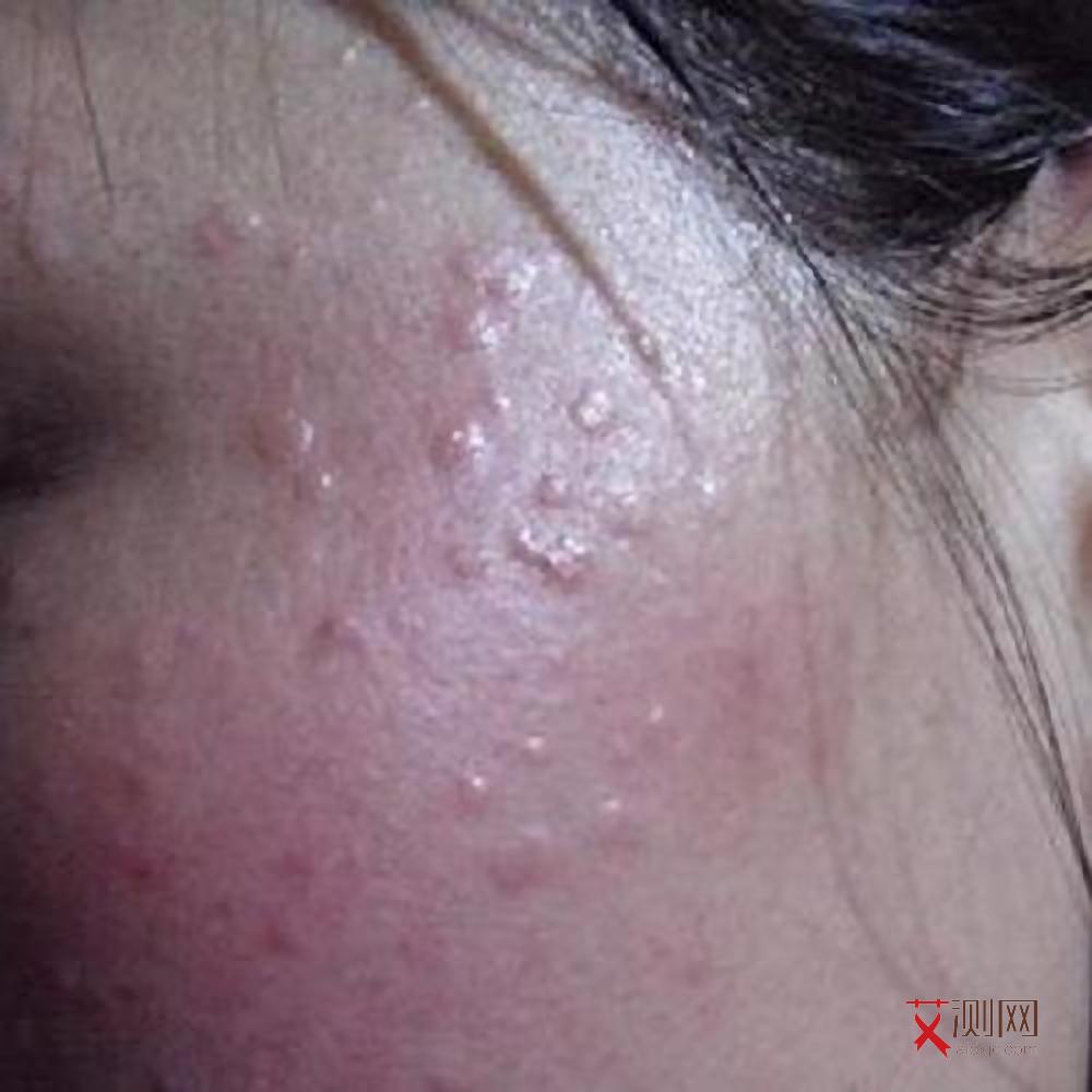 艾滋病男性下体会有什么症状吗