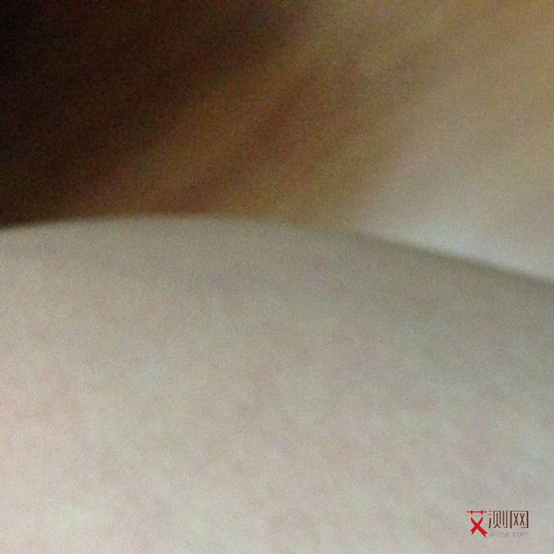 艾滋病的初期皮肤症状图片大全图解图