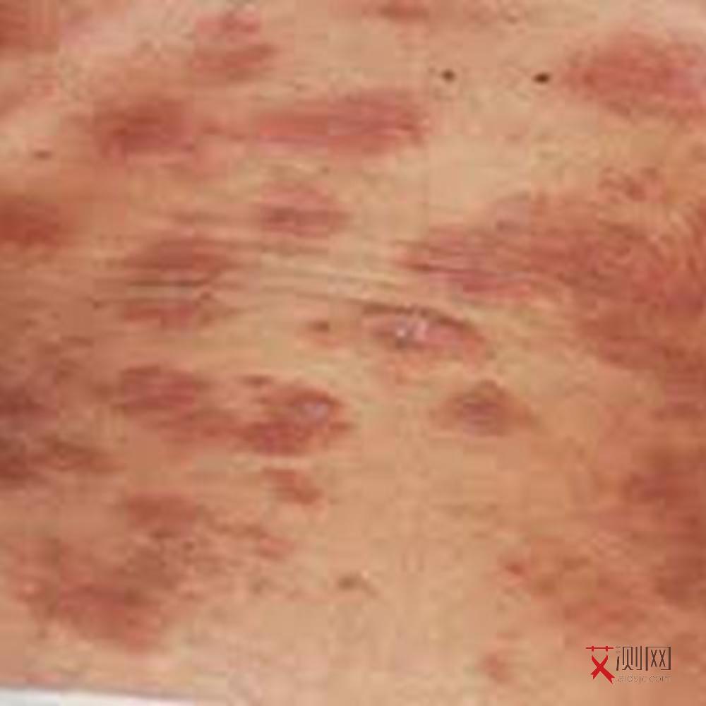 艾滋病感染后最快几天可产生症状出现