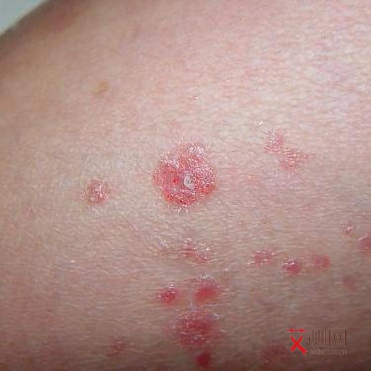 艾滋病药物皮疹会痒吗