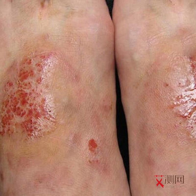 艾滋病的前期征兆是什么症状