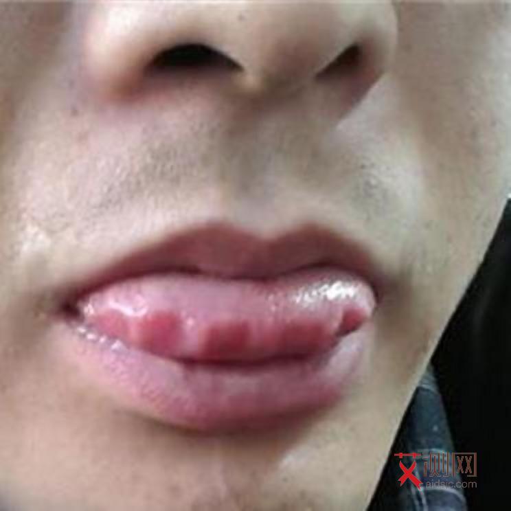 艾滋病身上会出现小红点吗会痒吗