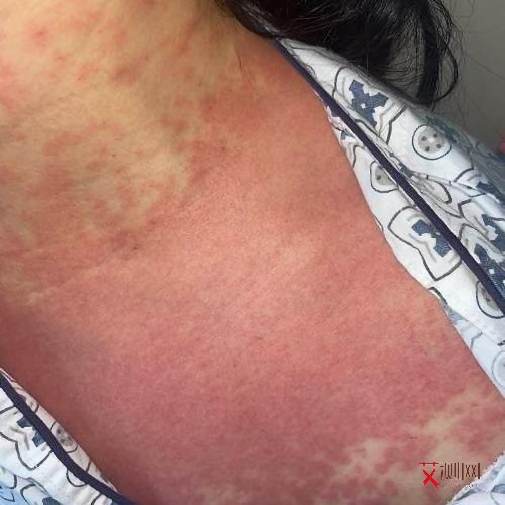 艾滋病长期咳嗽是什么样子的