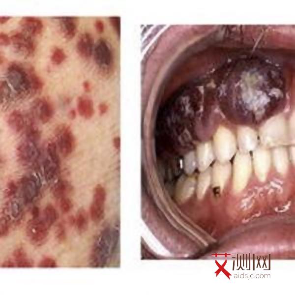艾滋病常见的症状结核病是什么病