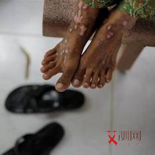 艾滋病初期症状皮疹在哪个部位出现图片