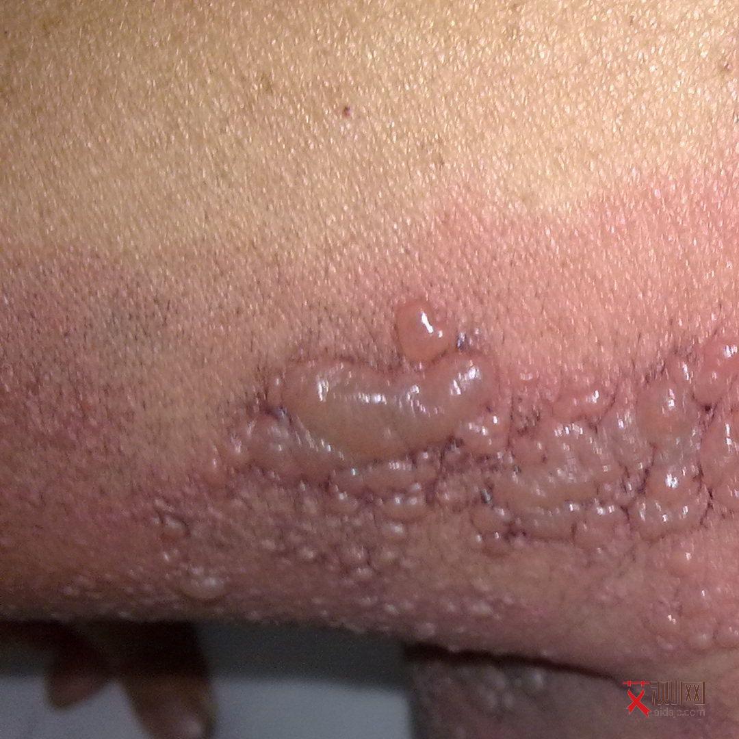 艾滋病的人什么症状